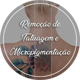 Remoção de tatuagem e de micropigmentação