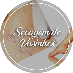 Secagem de vasinhos (Escleroterapia com glicose)